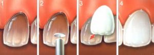 Как именно ставят виниры на зубы в стоматологии