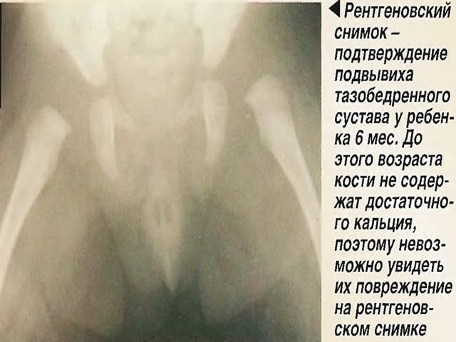 Рентгеновский снимок подвывиха бедренной кости у ребенка