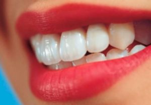Как проводится наращивание зубов и его преимущества