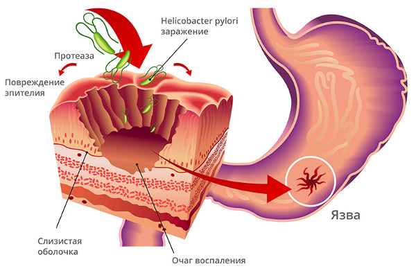 Схематичное изображение эрозии желудка