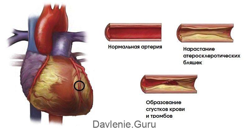 Атеросклероз коронарных артерий сердца