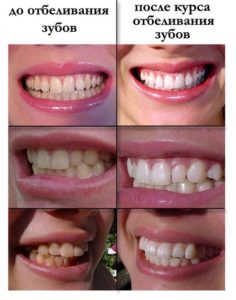 Как проводится отбеливание зубов