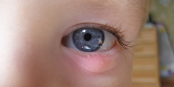 Воспаление глаза у ребенка