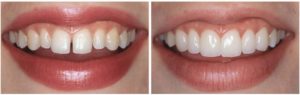  виниры на зубы в стоматологии