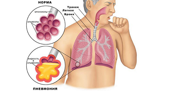 Что такое пневмония