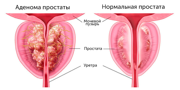 Аденома простаты