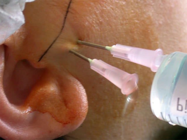 Что такое артроз челюстно-лицевого сустава и как его лечить