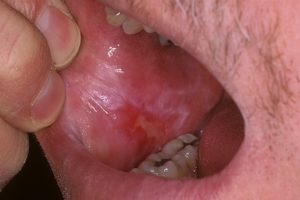 Симптомы и лечение красного плоского лишая в полости рта