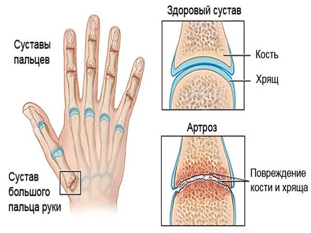 почему возникает заболевание суставов пальцев рук