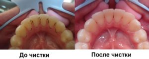 удаление налета на зубах 