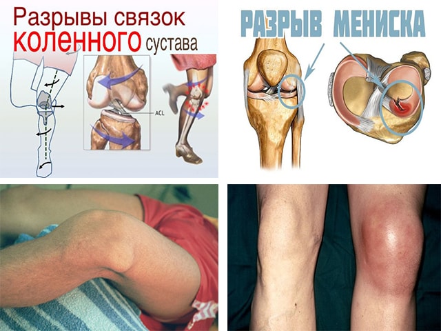 Причины и симптомы болей в колене сбоку с внутренней стороны