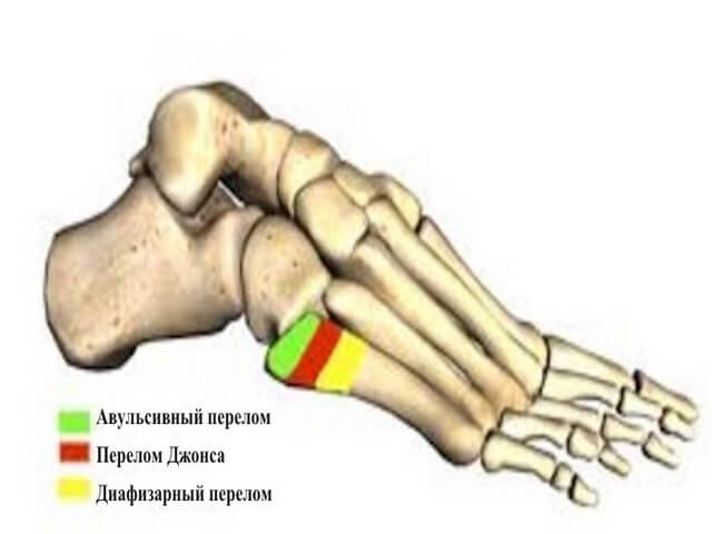Различные переломы кости