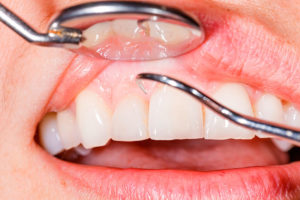 мазь можно выбрать от пародонтоза зубов