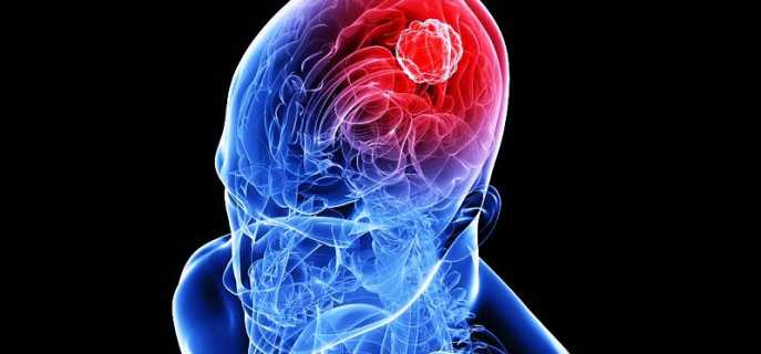 Симптомы и диагностика глиомы головного мозга