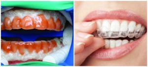 плюсы и минусы лазерного отбеливания зубов