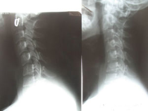 рентген снимок шейного отдела