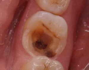  лечение острого пульпита зуба