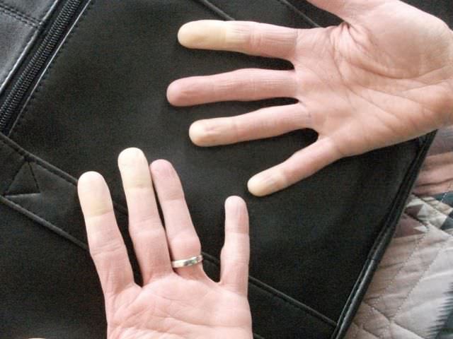 причины и лечение артроза пальцев рук