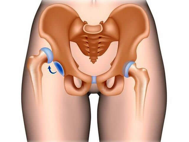 Повреждение бедра