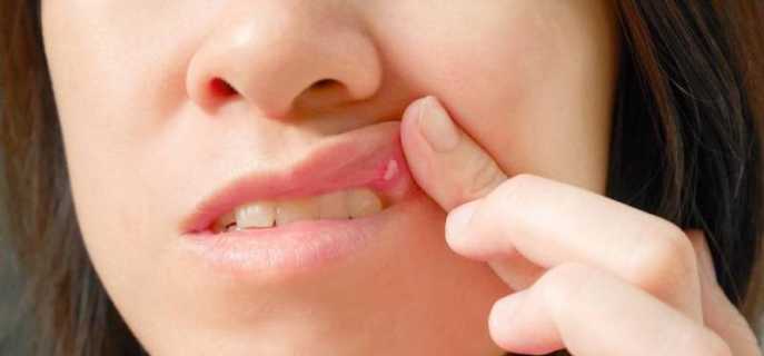 Причины, симптомы и лечение онемения верхней губы