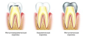 разновидности коронок на зубы