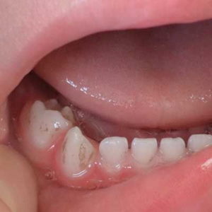 Как лечится черный налет на зубах у взрослых и детей