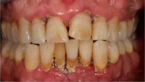  коричневый налет на зубах и способы избавления от него