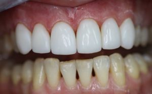  реставрационное отбеливание зубов