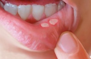 Какие заболевания провоцируют развитие сыпи во рту