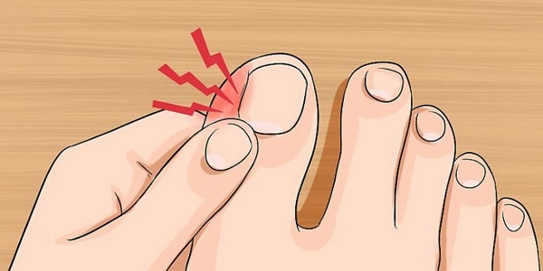 Как безболезненно выполнить лечение вросшего ногтя народными средствами