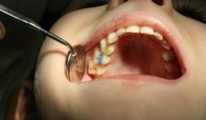 Симптомы и лечение пульпита молочных зубов у детей