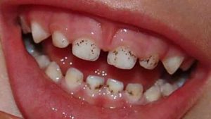 черный налет на зубах у взрослых и детей