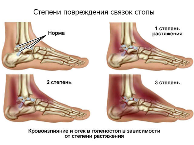 Схема травмирования ноги
