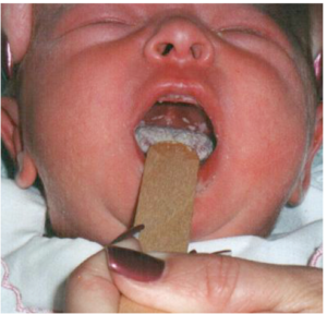  Стоматит у ребенка 1 год – симптоматика и правила лечения