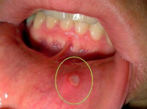 Почему появляется сыпь на слизистой полости рта и лечение