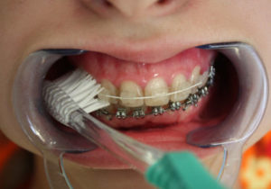 Как проводится чистка зубов с брекетами