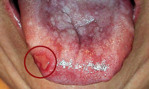 лечение красного плоского лишая в полости рта