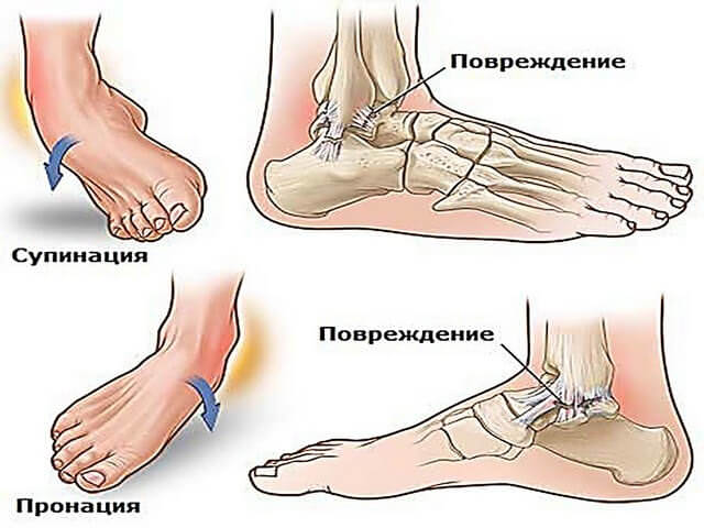 Повреждения нижней части ноги