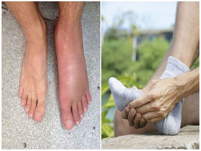 Как проявляется артрит стопы и как его лечить?