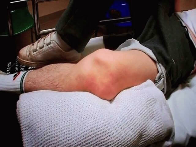 Сильная травма в коленной чашечке