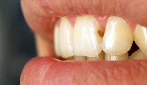 Почему появляется кариес между зубами и лечение