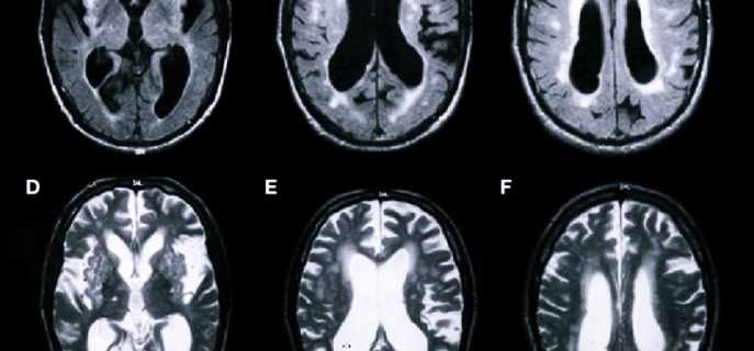 Этапы проведения и противопоказания МРТ сосудов головного мозга