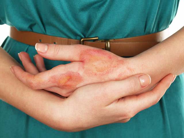 Зарубцевавшаяся кожа на руке после термического ожога