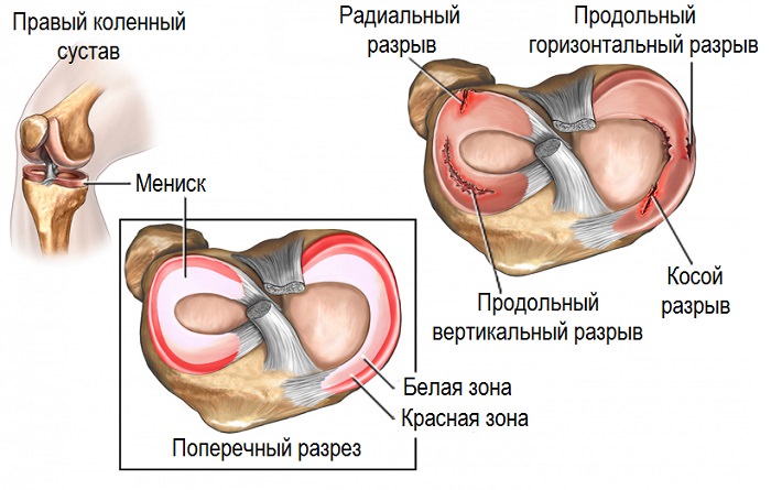 Разрывы в мышце коленного сустава
