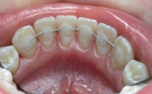 Как действует конструкция на зубы