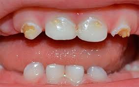 Симптомы и лечение кариеса молочных зубов у детей раннего возраста
