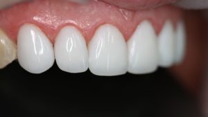 Как проводится реставрационное отбеливание зубов