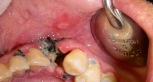 появляется альвеолит после удаления зуба 