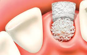  альвеолита после удаления зуба