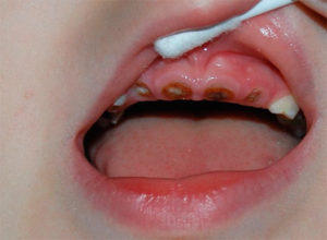 лечение кариеса молочных зубов у детей